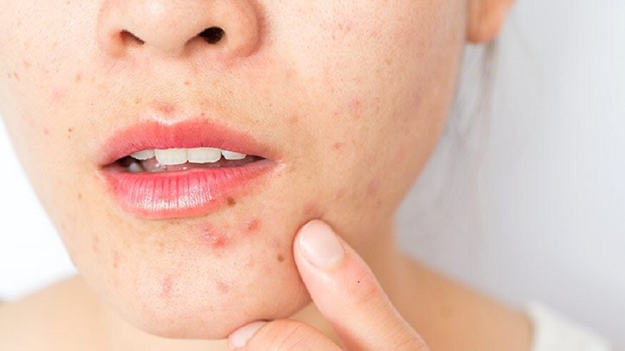 American Academy of Dermatology (AAD), நடத்திய ஆய்வில் பெண்களுக்கு பதின் பருவத்தில் தொடங்கும் முகப்பருக்கள் 25 வயது வரை நீடிக்கும் என்கிறது. மேலும் முகப்பருக்கள் வருவது சரியான தூக்கம் இல்லை, மன அழுத்தம் என்றாலும் அதன் தாக்கம் பருக்கள் மூலமாகவே வெளிப்படும். ஆனால் RMIT பல்கலைக்கழகம் School of Applied Sciences நடத்திய ஆய்வில் நாம் சாப்பிடும் உணவுதான் முகப்பருக்கள் வர முக்கிய காரணமாக இருக்கிறது என கண்டறிந்துள்ளது. American Academy of Dermatology (AAD), நடத்திய ஆய்வில் பெண்களுக்கு பதின் பருவத்தில் தொடங்கும் முகப்பருக்கள் 25 வயது வரை நீடிக்கும் என்கிறது. மேலும் முகப்பருக்கள் வருவது சரியான தூக்கம் இல்லை, மன அழுத்தம் என்றாலும் அதன் தாக்கம் பருக்கள் மூலமாகவே வெளிப்படும். ஆனால் RMIT பல்கலைக்கழகம் School of Applied Sciences நடத்திய ஆய்வில் நாம் சாப்பிடும் உணவுதான் முகப்பருக்கள் வர முக்கிய காரணமாக இருக்கிறது என கண்டறிந்துள்ளது.