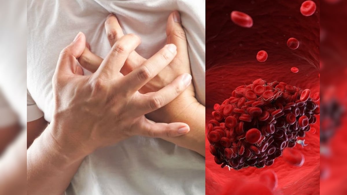 Blood Clot symptoms and meaning in Tamil News18 தமிழ்