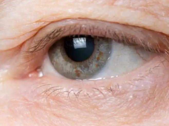  இமை வாதம் (Ptosis) : தசைகளுக்கு ஏற்படும் பக்கவாதத்தினால், கண்ணின் மேலிமை பாதிப்புக்குள்ளாகும். பார்வை குறைபாட்டை ஏற்படுத்தும் இந்த நோய், டோடோசிஸ் அல்லது பிளெபரோப்டோசிஸ் என்று அழைக்கப்படுகிறது. இது பிறந்ததிலிருந்தே இருந்திருக்கலாம் மற்றும் பொதுவாக தீங்கற்றதாக இருக்கலாம் என்றும் நம்பப்படுகிறது. ஆனால் இது உங்கள் மூளை, நரம்புகள் அல்லது கண் சாக்கெட் ஆகியவற்றில் ஏதேனும் சிக்கல் ஏற்படுவதைக் குறிக்கலாம். பலவீனமான தசைகள், உணவு அல்லது தண்ணீர் விழுங்குவதில் சிக்கல், கடுமையான தலைவலி அல்லது இரட்டைப் பார்வை ஆகிய அறிகுறிகள் இருந்தால் மருத்துவரை உடனே அணுகவும்.