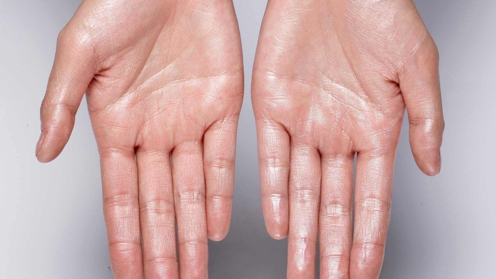 உள்ளங்கையில் அதிகமாக வியர்வை வருகிறதா..? தவிர்க்க வேண்டிய வழிகளை விளக்கும் மருத்துவர்..!