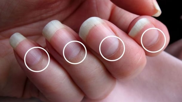 If You Do Not Have Half Moon Shape On Your Nails Immediately Visit A Doctor 14819 2
