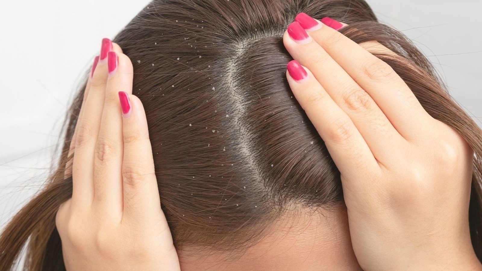 இந்த உணவுகளை சாப்பிட்டால் பொடுகுத் தொல்லையே இருக்காது : தினசரி உணவில் சேத்துக்கோங்க...