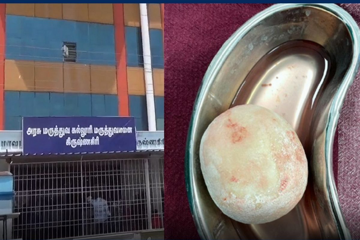 இளைஞரின் சிறுநீரகப் பையில் இருந்த 300கிராம் கல் அகற்றம்