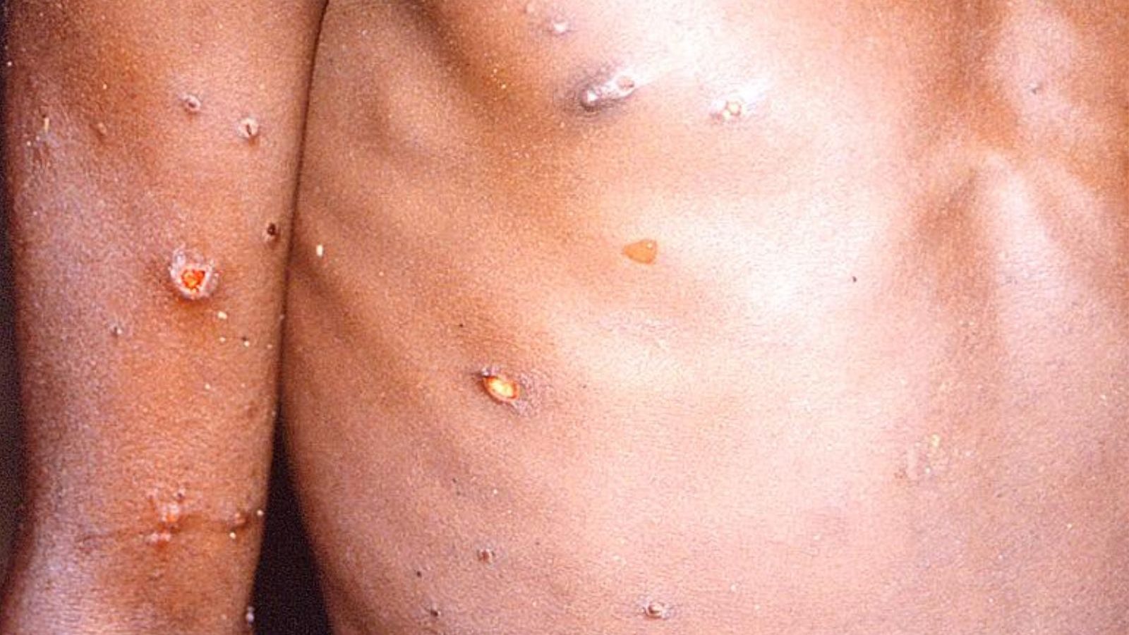 இந்தியாவை அச்சுறுத்தும் குரங்கு அம்மை...WHO சர்வதேச சுகாதார அவசரநிலையாக அறிவிப்பு...