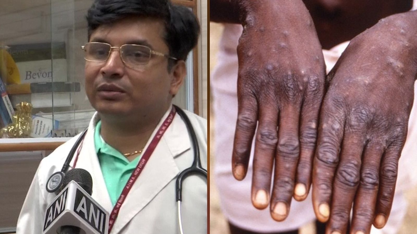 மங்கிபாக்ஸ் தொற்று குழந்தைகளுக்கு பரவினால் பெரும் ஆபத்து - எய்ம்ஸ் நிபுணர் எச்சரிக்கை!