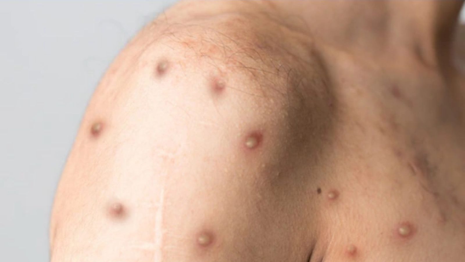 டெல்லியிலும் பரவிய குரங்கம்மை தொற்று.. இந்தியாவில் பாதிப்பு எண்ணிக்கை 4ஆக அதிகரிப்பு