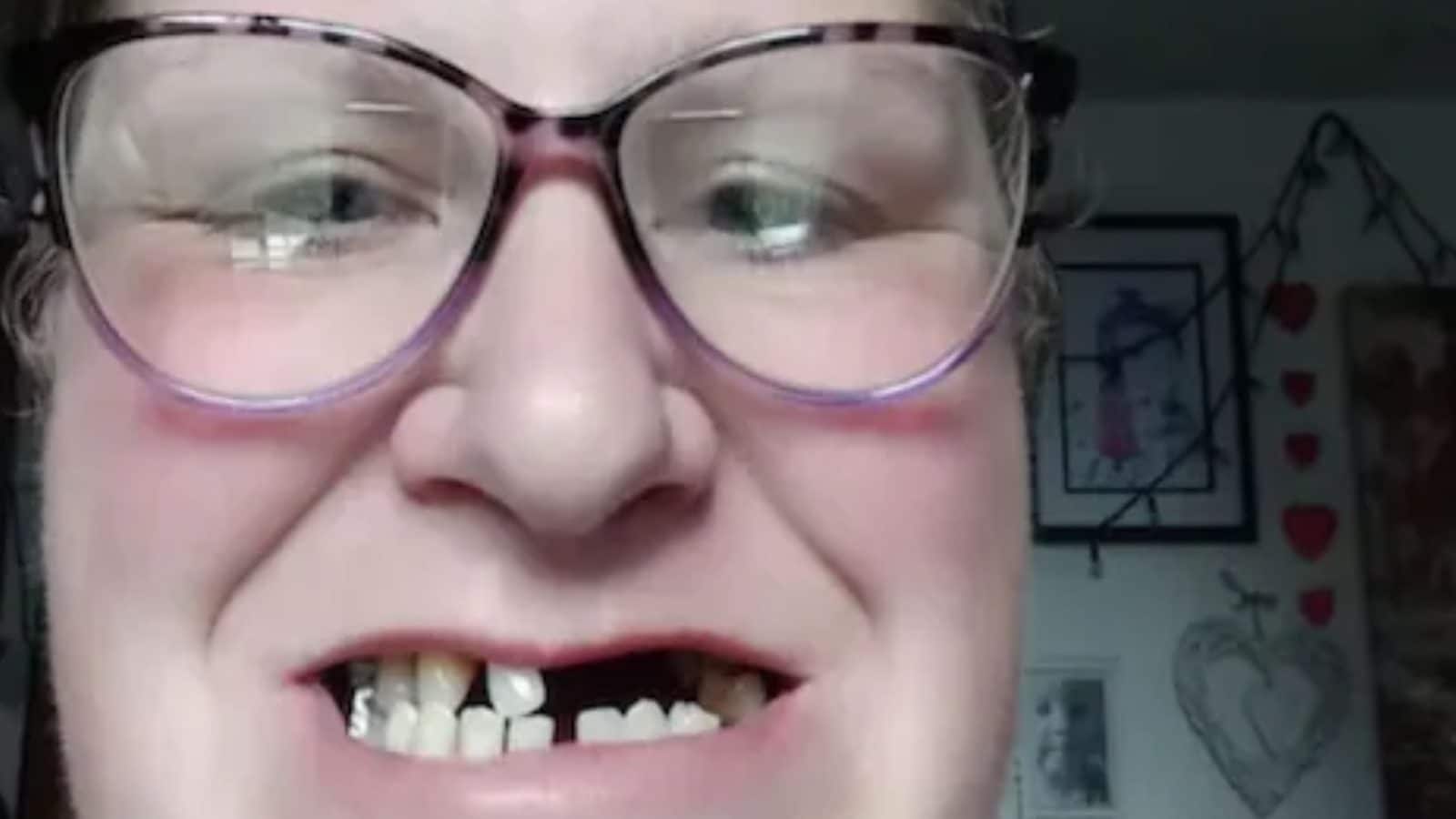 தனது 13 பற்களை தானே வலுக்கட்டாயமாக பிடுங்கிய பெண்மணி! ஏன்? எதற்காக இப்படி செய்தார்?