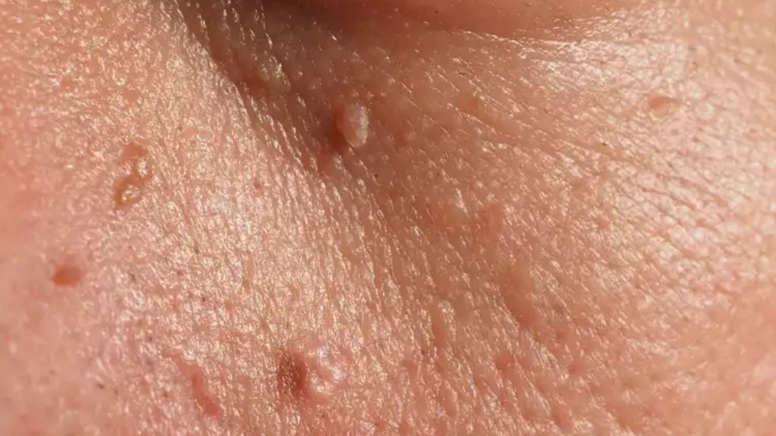 எச்சரிக்கை... தோலில் மருக்கள் ஏற்படுவது நீரிழ்வு நோய்க்கான அறிகுறியா..?