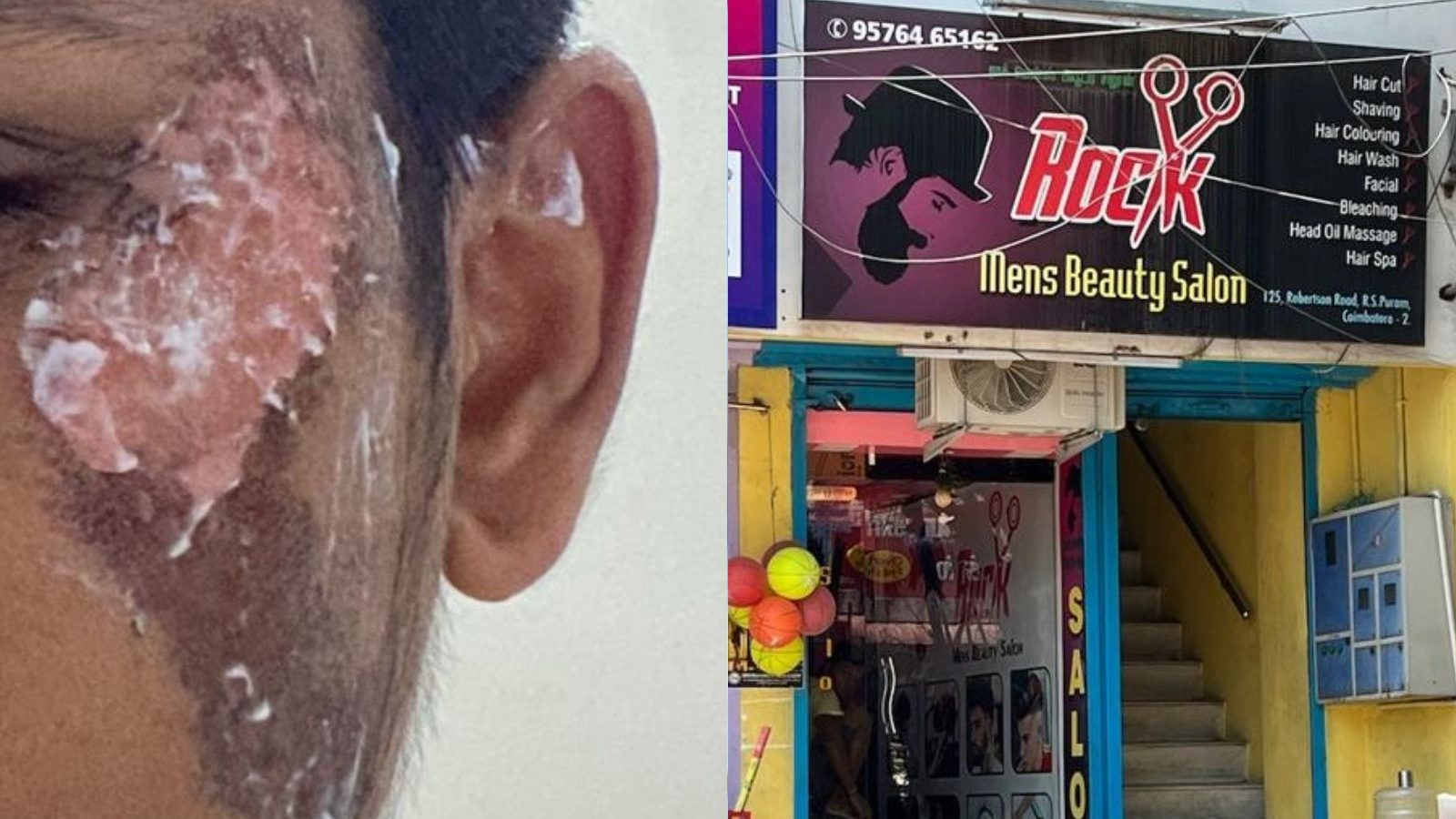 ஃபேசியல் செய்த சிறுவன்.. வெந்து போன முகம் -  கோவையில் நடந்த அதிர்ச்சி சம்பவம்