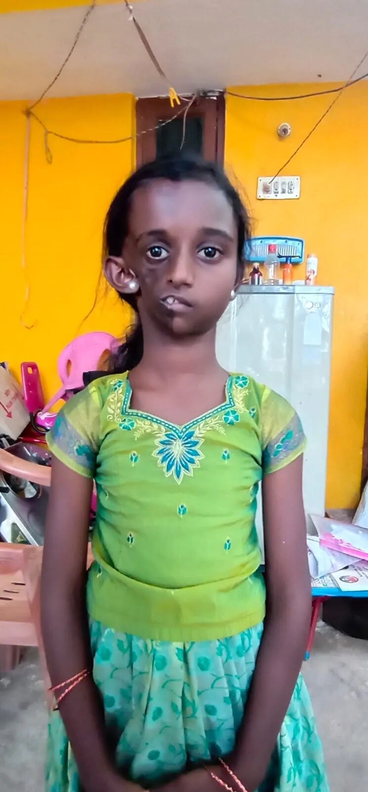 குழந்தை டான்யாவுக்கு அறுவை சிகிச்சை வெற்றிகரமாக நிறைவு… போனில் நலம் விசாரித்த முதலமைச்சர்