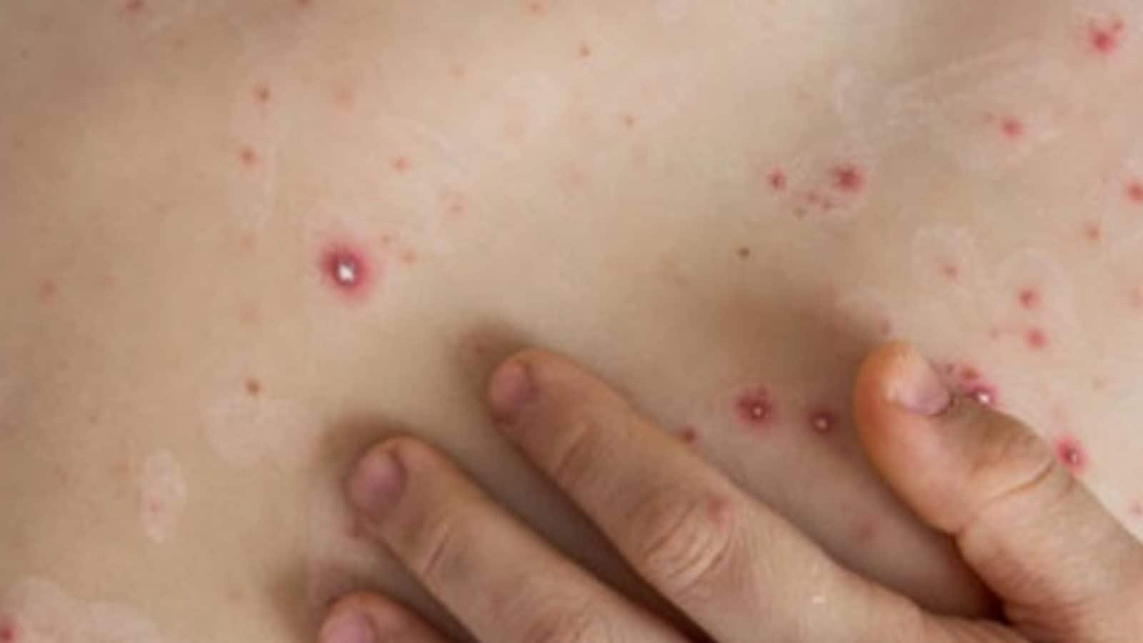 இந்தியாவில் 82 குழந்தைகளுக்கு பரவியுள்ள தக்காளி காய்ச்சல்.. இதன் பாதிப்பு என்ன?