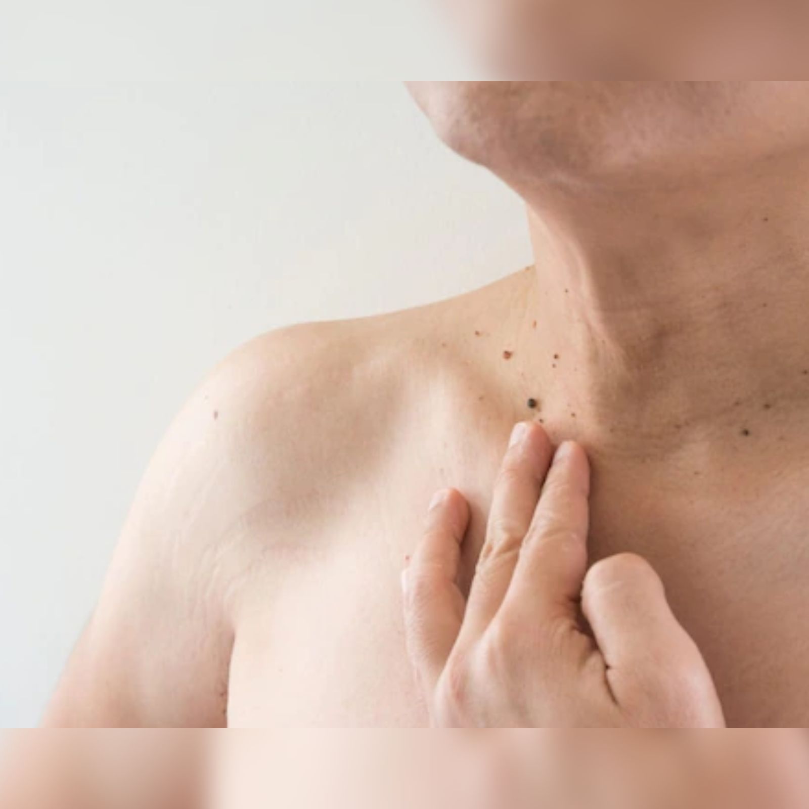  Home Remedies for Wart : சருமத்தில் ஒவ்வாமை மற்றும் தொற்று என வந்து போவது சகஜம். இதை நாம் சரியான பராமரிப்பின் மூலம் மட்டுமே தவிர்க்க முடியும். அந்த வகையில் பலருக்கும் பெரிய பிரச்சனையாக இருப்பது மருக்கள். இதனால் உடலி எந்த பாதிப்பும் இல்லை என்றாலும் தோற்றத்தின் அழகை கெடுப்பதாக இருக்கும். மருக்கள் ஏற்படுவதற்கு மிகப்பெரிய காரணம் மனித பாப்பிலோமா வைரஸ் ஆகும். இது சருமத்தை வெகுவாக பாதிப்பதாலேயே மருக்கள் உருவாகின்றன.