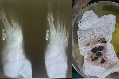 
காலின் உள்ளே சிக்கிய கற்கள் 