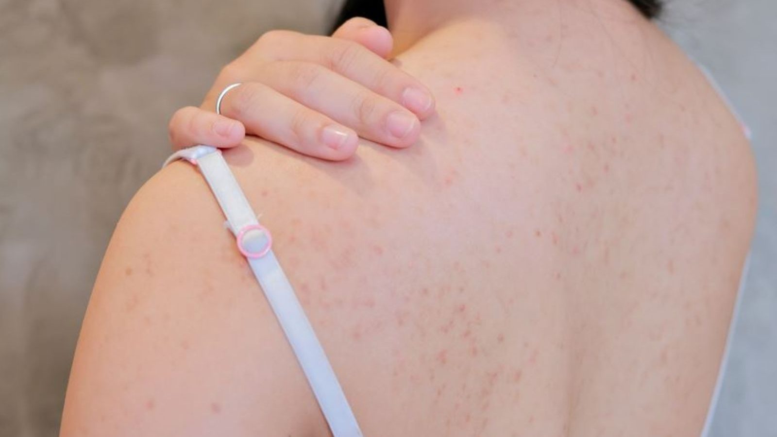 முதுகில் ஏற்படும் பருக்களால் சங்கடமாக உள்ளதா..? இந்த 5 விஷயங்களை ஃபாலோ பண்ணுங்க..!