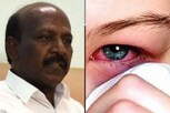 ஒரு நாளைக்கு 4500 பேருக்கு மெட்ராஸ் ஐ வருது.. அமைச்சர் மா.சு தகவல்