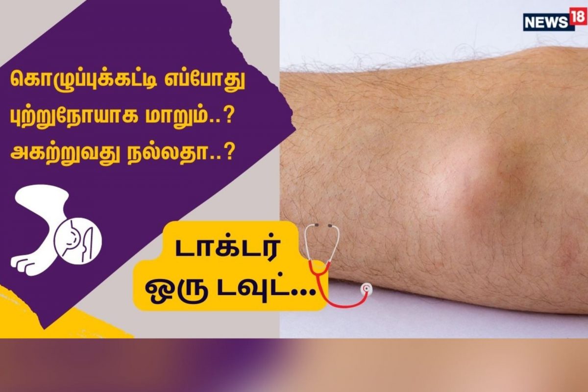 டாக்டர் ஒரு டவுட் : கொழுப்புக்கட்டி எப்போது புற்றுநோயாக மாறும்..?