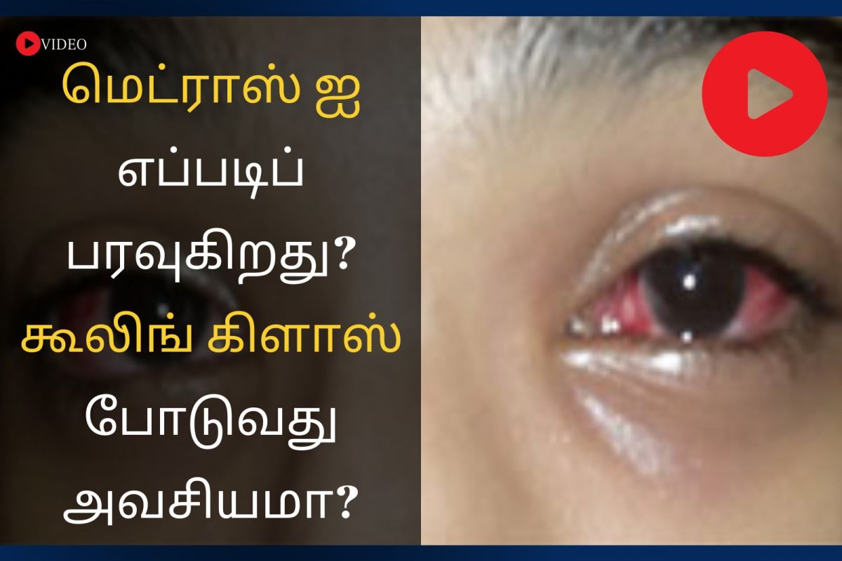 மெட்ராஸ் ஐ 