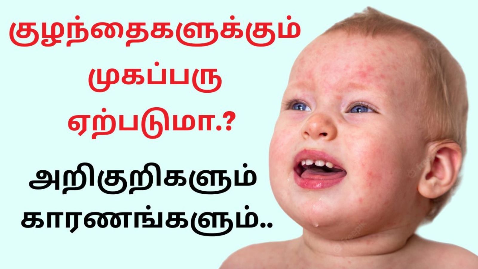 குழந்தைகளுக்கும் முகப்பரு ஏற்படுமா..? அறிகுறிகளும் காரணங்களும்..!