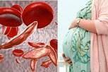 sickle cell anaemia : அரிவாள் செல் ரத்த சோகை கர்ப்பத்தை பாதிக்குமா..?