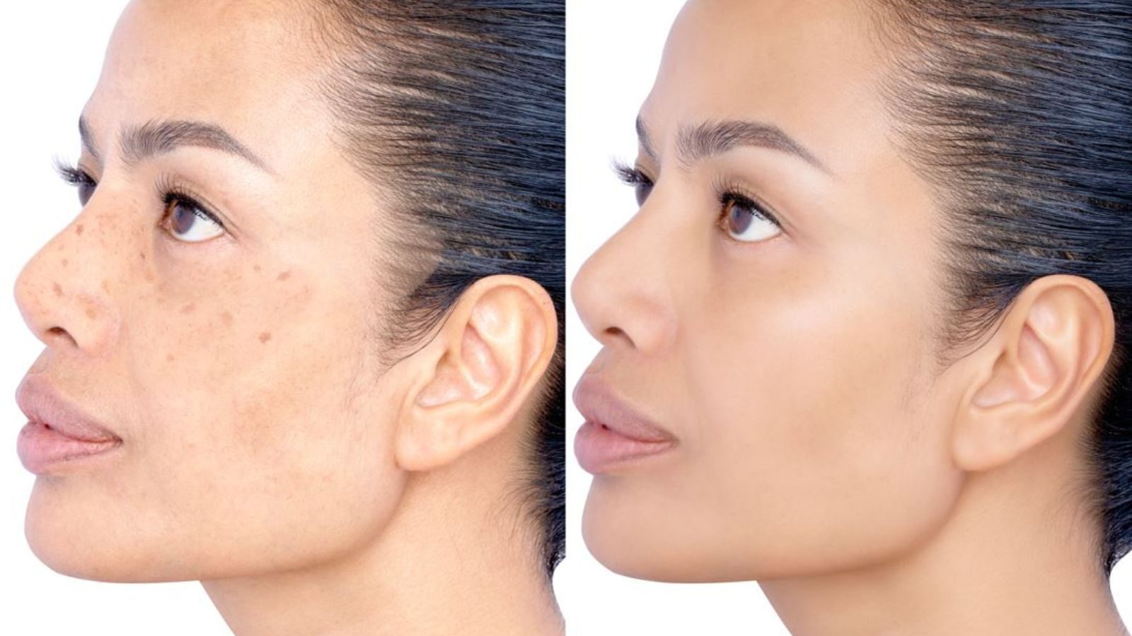 முகத்தில் கரும்புள்ளியா..? கவலை வேண்டாம்.. இந்த சிகிச்சைகளை பின்பற்றினாலே நல்ல ரிசல்ட் கிடைக்கும்..!