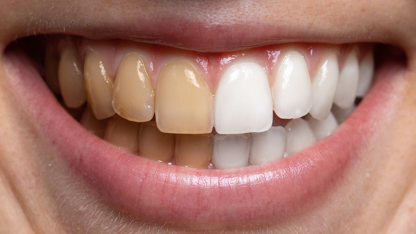 பற்கள் பளிச் என வெண்மையாக வேண்டுமா? விலையுயர்ந்த பற்பசை வேண்டாம்... இத மட்டும் பயன்படுத்துங்க..!