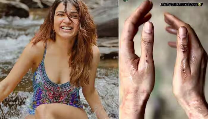  நடிகை சமந்தா தனது கைகளில் படுகாயம் அடைந்த நிலையில் புகைப்படம் ஒன்றை வெளியிட்டுள்ளார். இதனால் அவரது ரசிகர்கள் அதிர்ச்சியடைந்துள்ளனர்.