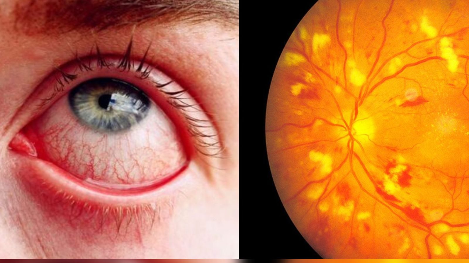 உயர் ரத்த அழுத்தம் இருந்தால் கண் பார்வை பாதிக்கப்படுமா..?