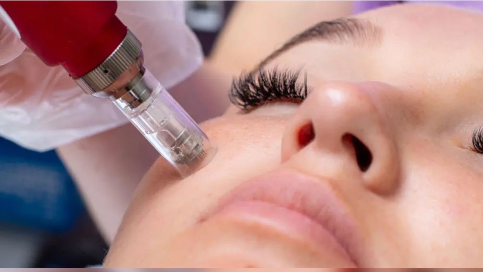 மைக்ரோ நீடிலிங் மூலம் முகப்பருக்களை அகற்றும் சிகிச்சை பலன் தருமா..? முழுமையான தகவல்.!