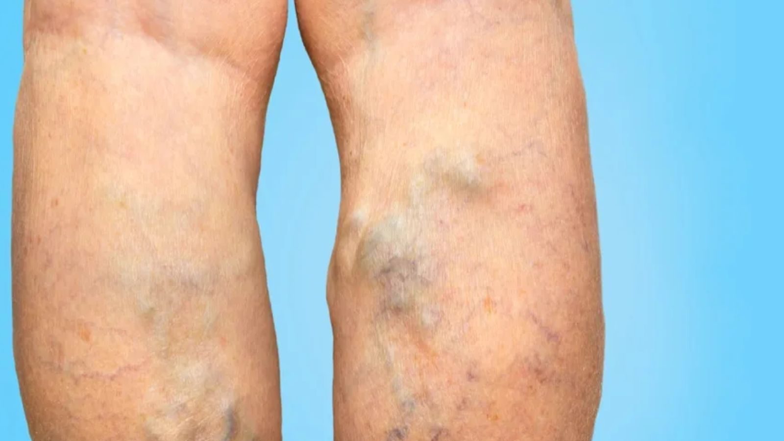 இந்த 4 இடங்களில் அறிகுறி இருந்தால் கொலஸ்ட்ரால் அதிகரித்துவிட்டதாக அர்த்தம்..!