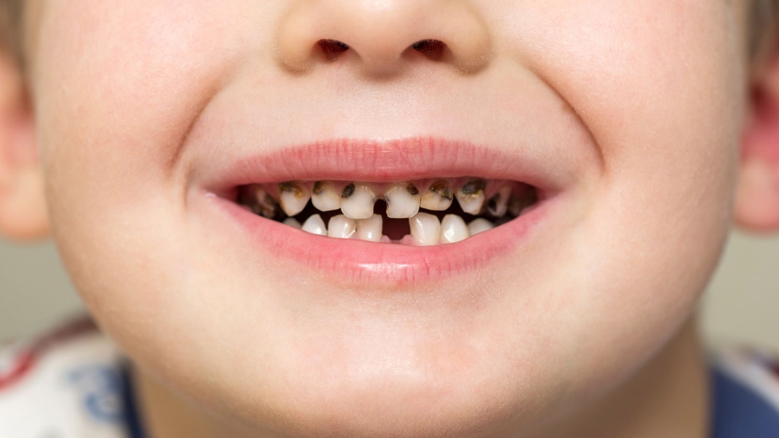 பெற்றோர்கள் கவனத்திற்கு... உங்கள் குழந்தைளுக்கு பற்சிதைவா..?  தடுக்க இவற்றை செய்யுங்கள்!