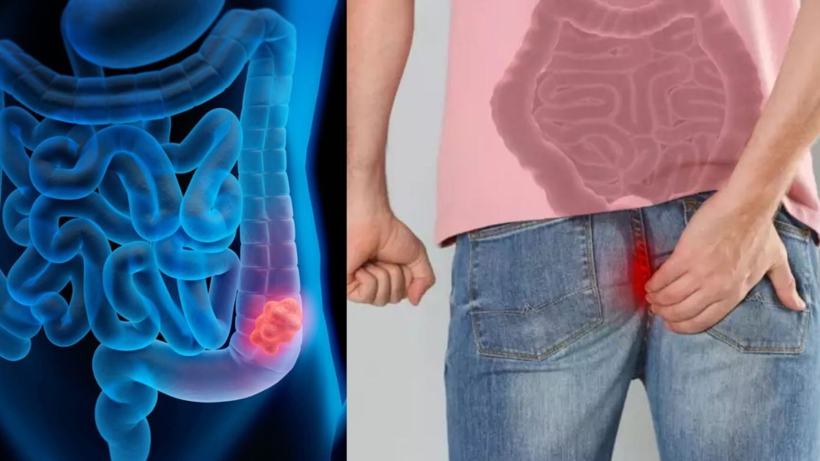 அச்சுறுத்தும் பெருங்குடல் புற்றுநோய்... இந்த அறிகுறிகளில் உஷாராக இருங்கள்..!