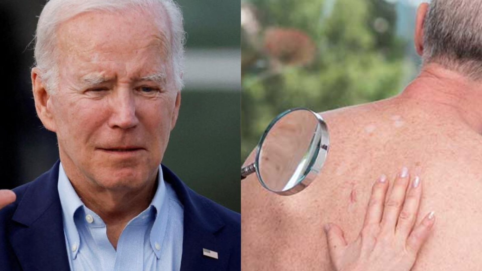 ஜோ பைடனுக்கு தோல் புற்றுநோய் அகற்றம்... எப்படி கண்டுபிடிப்பது? என்னென்ன பாதிப்புகள் ஏற்படும்? விரிவான தகவல்..!