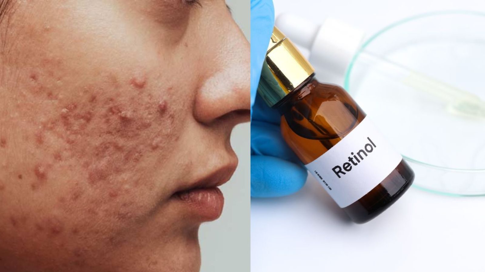 ரெட்டினால் கெமிக்கலை இப்படி பயன்படுத்தினால் ஆபத்தா..? கட்டுக்கதைகளும்.. உண்மைகளும்..