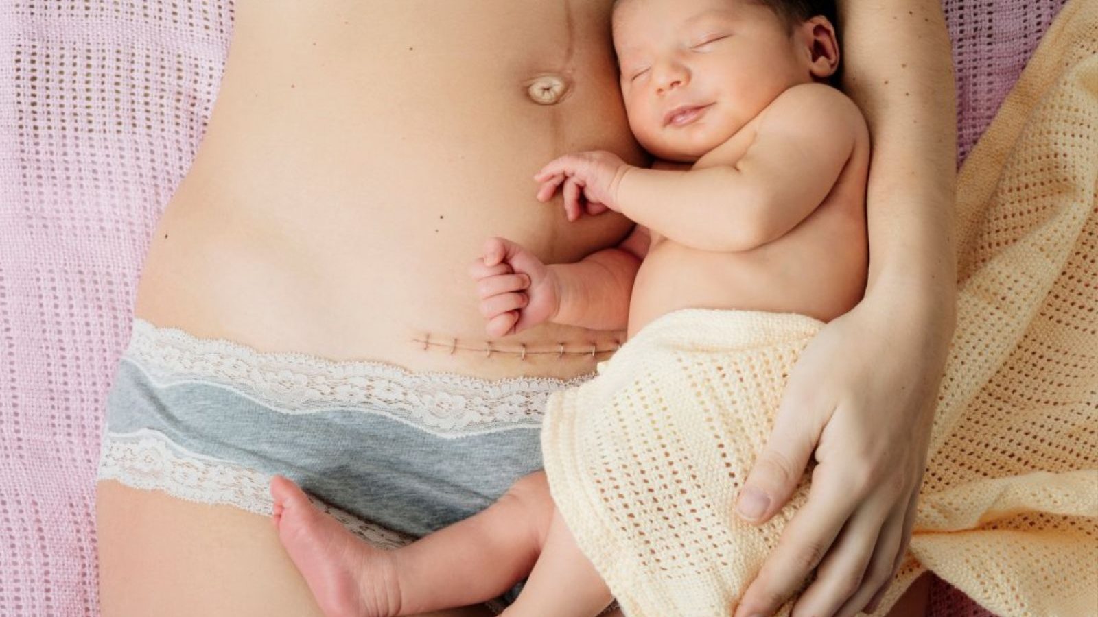 சிசேரியன் செய்த பின் முதுகுவலி ஏற்படுமா..? கட்டுக்கதைகளும்.. உண்மைகளும்..