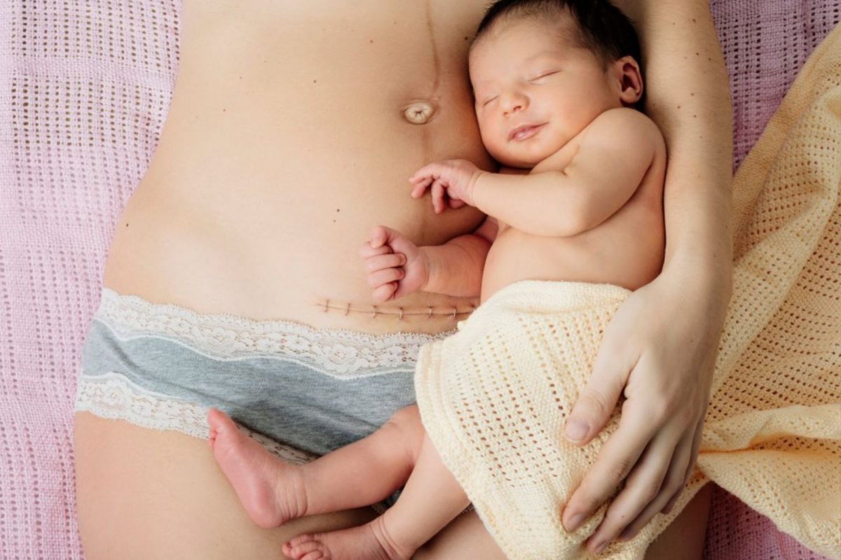 Caesarian