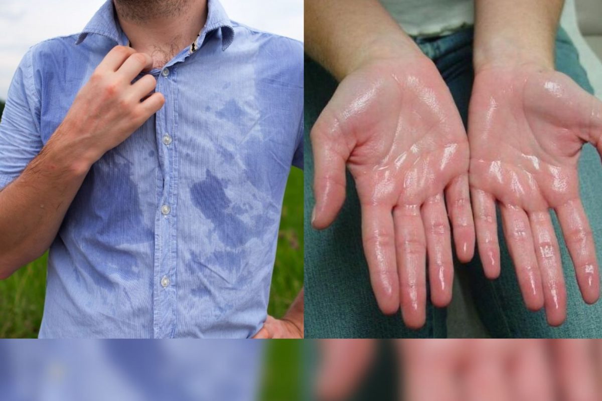 Hyperhidrosis