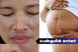 கர்ப்ப காலத்தில் தோல் கருமை , மங்குகள் ஏற்பட காரணம் என்ன..?