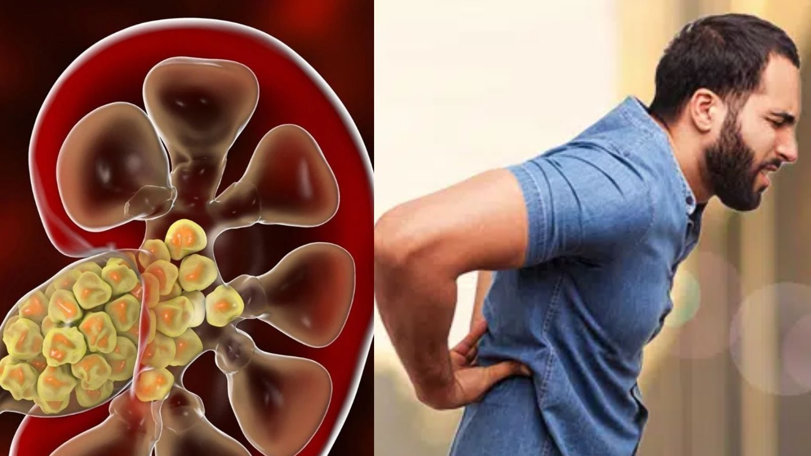 கோடைக்காலத்தில் ’சிறுநீரகக் கல்’ பிரச்சனை அதிகரிக்க என்ன காரணம்..? வராமல் தடுக்கும் வழிகள்.!