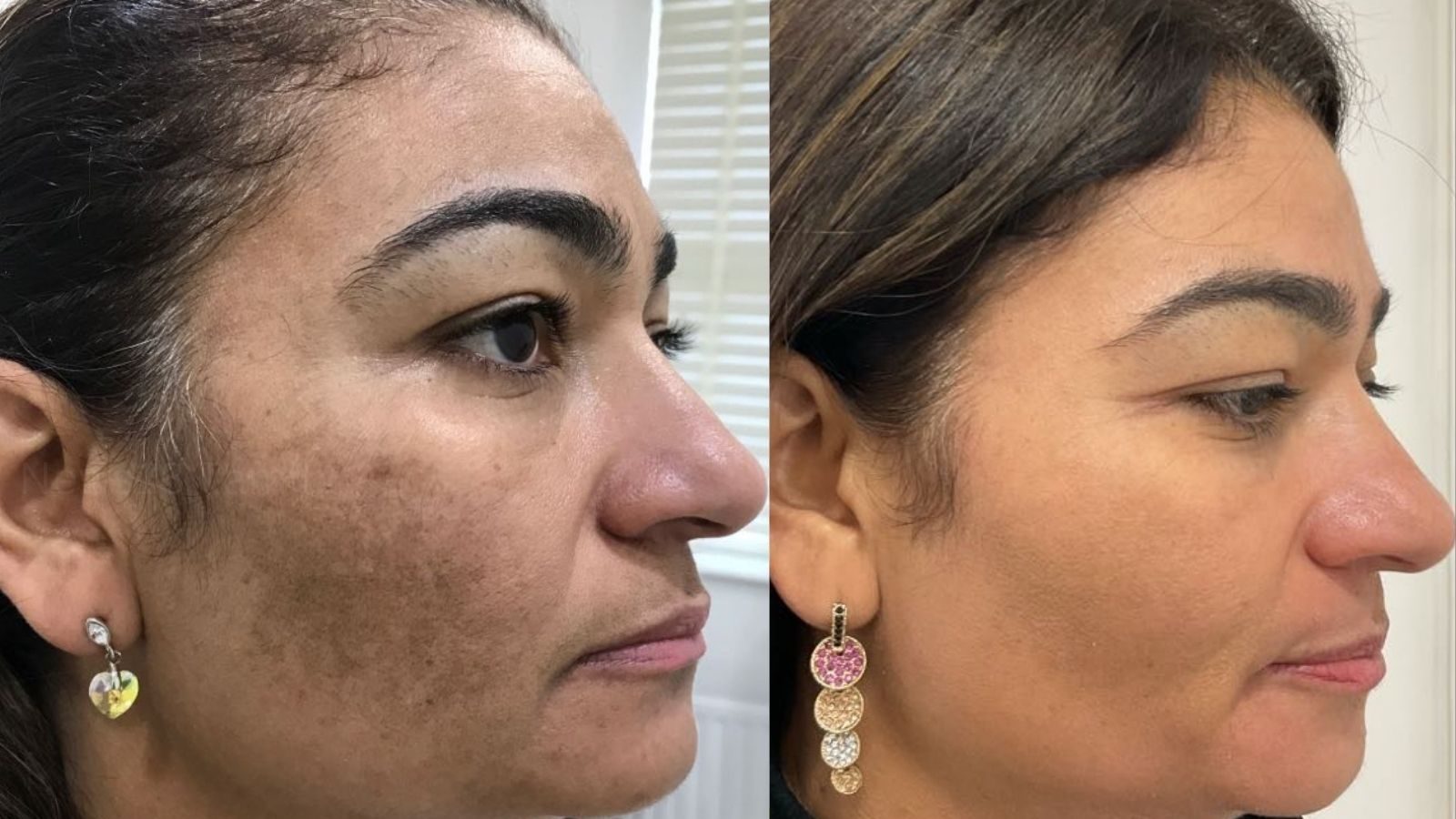 ஹைப்பர் பிக்மென்டேஷன் பிரச்சனையா..? இதை மட்டும் ட்ரை பண்ணுங்க... ஒரே வாரத்தில் நல்ல ரிசல்ட் கிடைக்கும்…!