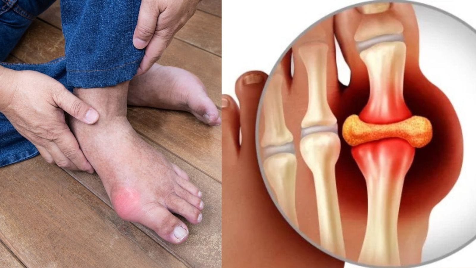 உடலில் யூரிக் ஆசிட் அதிகரிக்காம இருக்கனுமா..? அப்போ இதையெல்லாம் ஃபாலோ பண்ணுங்க..!