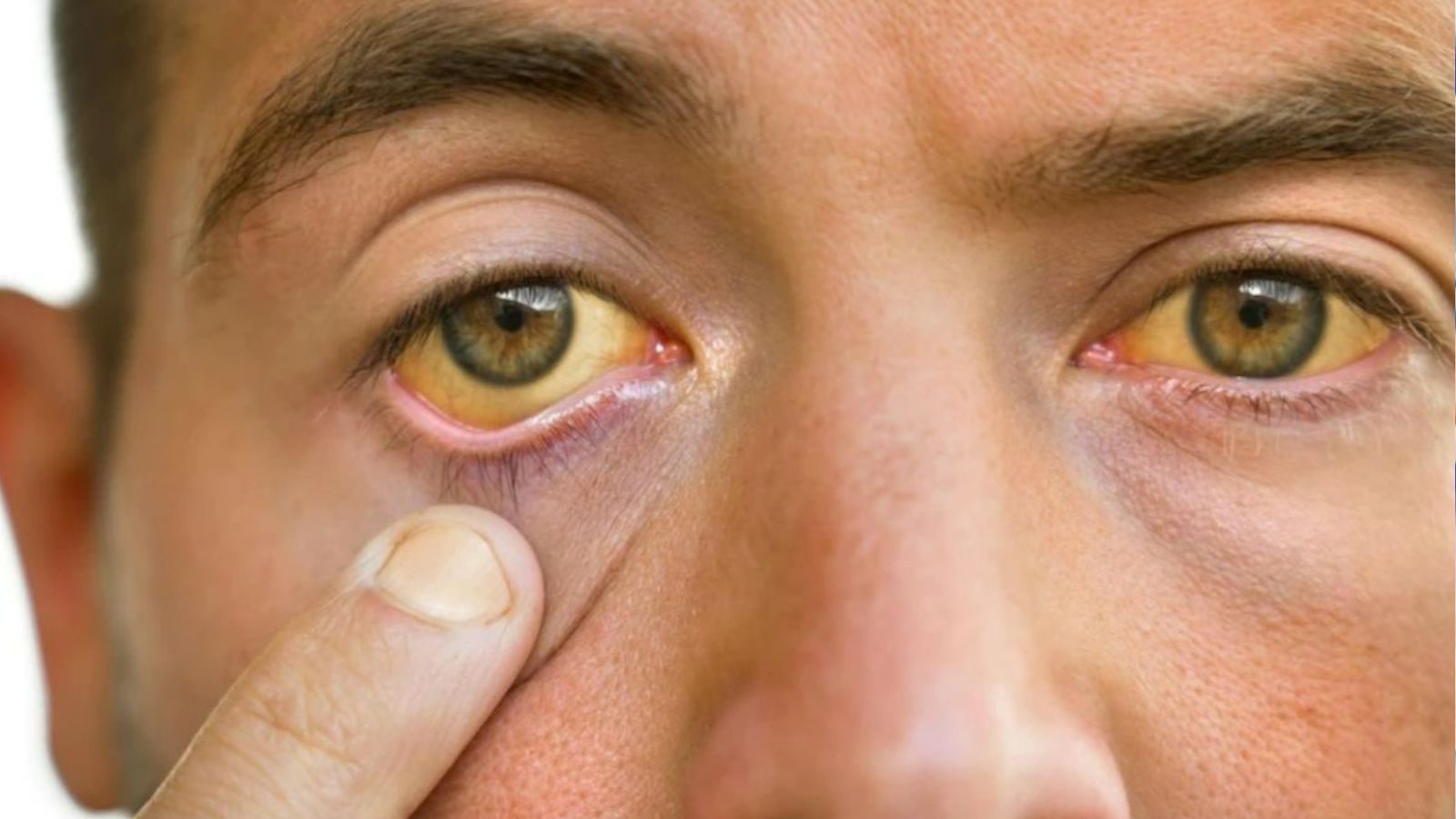 கொலஸ்ட்ரால் அபாய கட்டத்தை எட்டும்போது கண்களில் இந்த அறிகுறிகள் தெரியுமாம்.. உஷார்..!