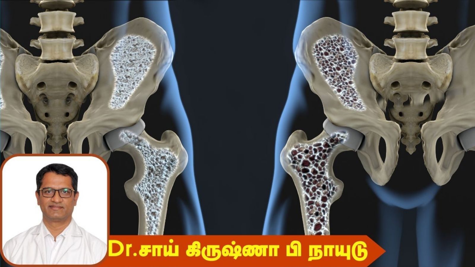 எலும்புப்புரை நோய் என்றால் என்ன..? இது யாருக்கெல்லாம் ஆபத்து..?