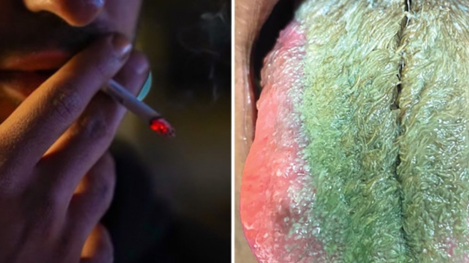 சிகரெட் இப்படி ஒரு பிரச்னையை கொடுக்குமா? நாக்கில் வளரும் முடியால் ஷாக்.. நடந்தது என்ன?