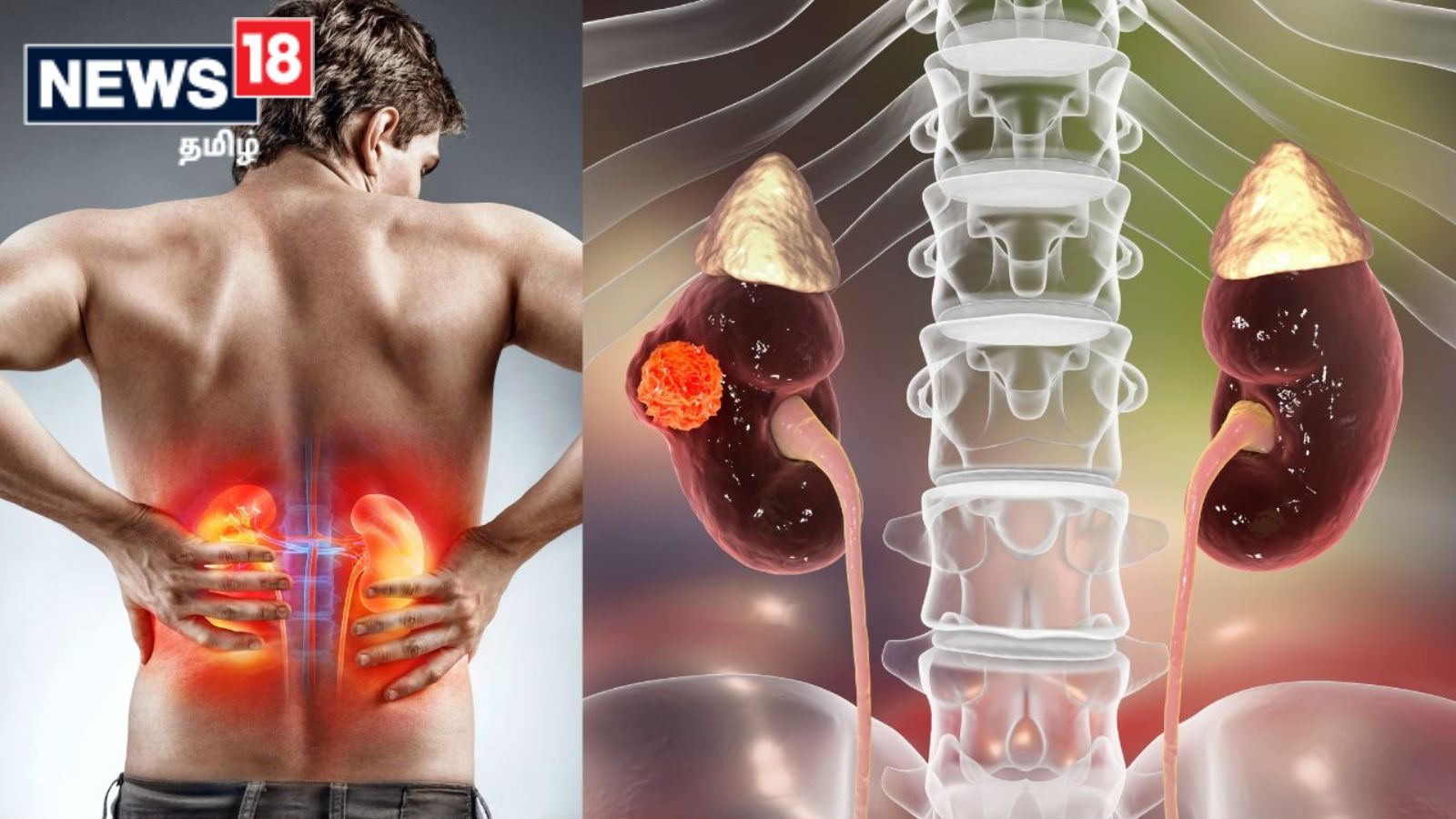 சிறுநீரக புற்றுநோய் பற்றிய கட்டுக் கதைகளும்.. உண்மைகளும்..!