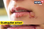 கர்ப்பகாலத்தில் ஏற்படும் அக்கி நோய் ( Herpes simplex) பற்றி  தெரியுமா?