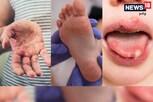 கை, கால் மற்றும் வாய்ப்பகுதியில் புதிதாக பரவும் வைரஸ் தொற்று...