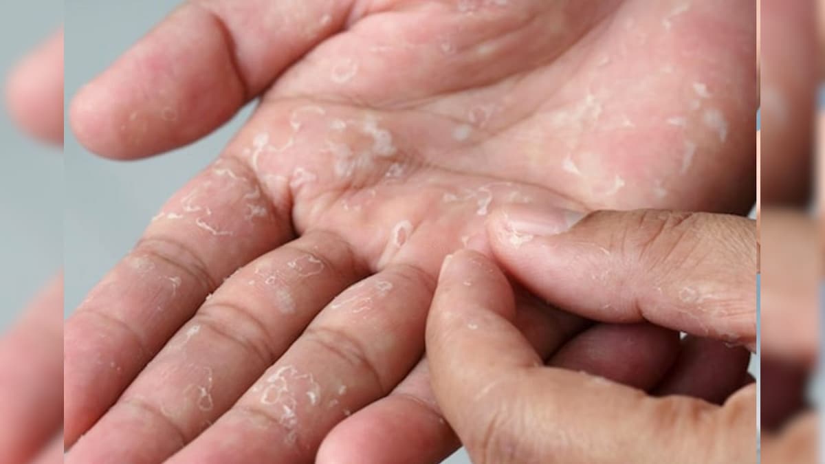 Skin Peeling On Hand | உங்க கைகளில் இப்படி தோல் உறிய என்ன காரணம் தெரியுமா..? சரி செய்வதற்கான வழிகள்..! – News18 தமிழ்