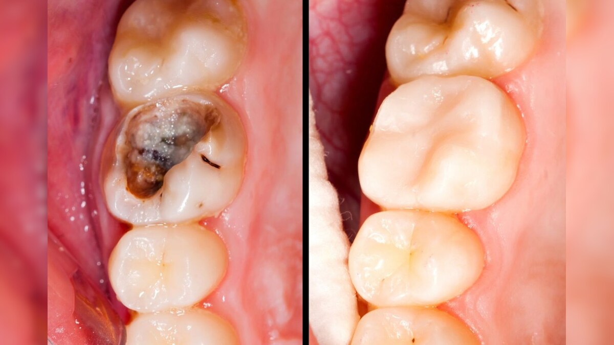 பல் சொத்தை வராமல் தடுப்பது எப்படி? இதற்கான சிகிச்சைகள் என்ன? – News18 தமிழ்
