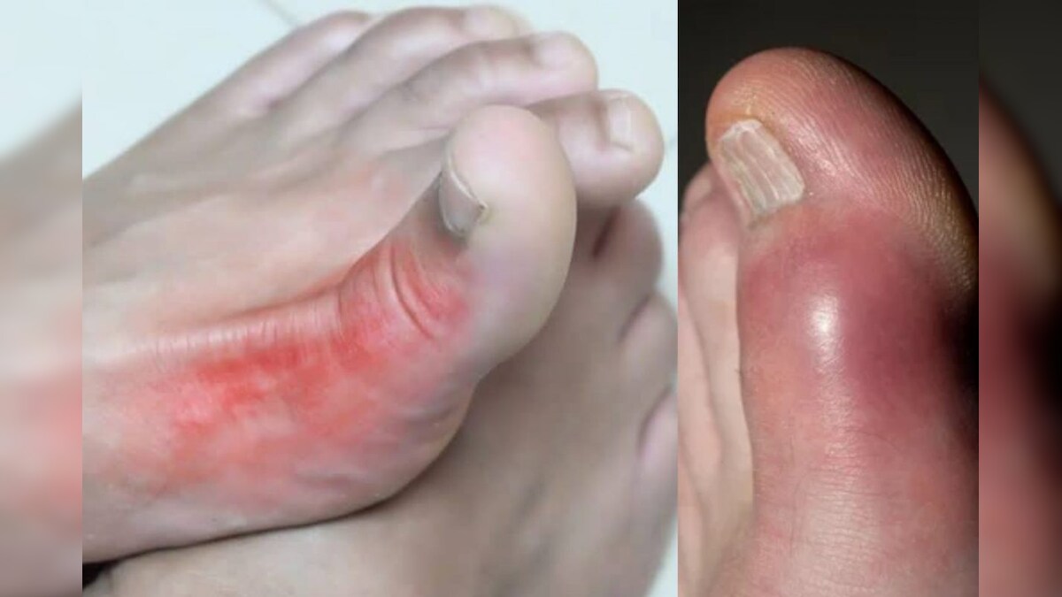 இந்த 6 உணவுகள் போதும்.. யூரிக் அமிலம் அளவை இயற்கையான முறையில் குறைச்சிடலாம்..! – News18 தமிழ்