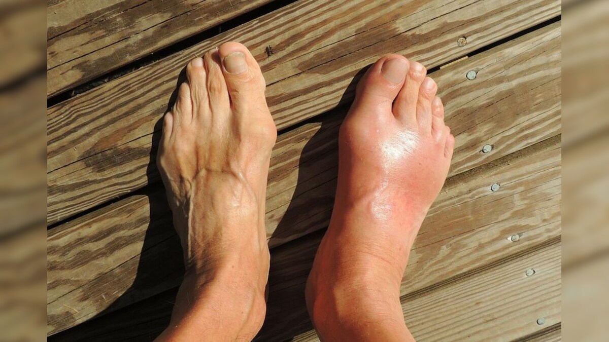 Uric Acid | ஆண்கள் மற்றும் பெண்களுக்கு யூரிக் அமிலம் பொதுவாக எவ்வளவு இருக்க வேண்டும்..? – News18 தமிழ்